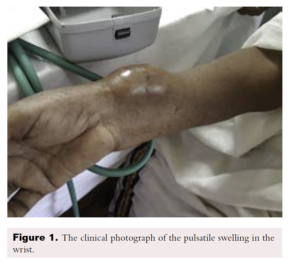 Radial Pseudoaneurysms Vascular Disease Management
